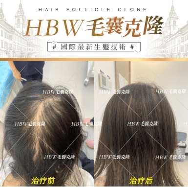 毛囊克隆技术最新进展报告，最新动态与突破